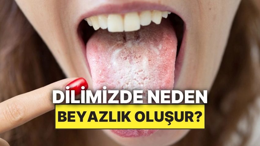 Lisanımızın Art Kısımlarında Oluşan Bu Beyazlığın Sebebi Nedir?