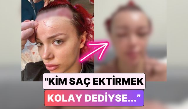 biz-sac-ekimi-ulkesiyiz-sac-ektirme-sureci-yaptiran-bir-bayan-yuzunun-geldigi-hali-paylasti-7tr3L3dp.jpg