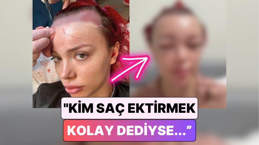 Biz Saç Ekimi Ülkesiyiz: Saç Ektirme Süreci Yaptıran Bir Bayan Yüzünün Geldiği Hali Paylaştı