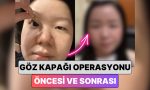 guney-korede-bir-bayan-en-yaygin-estetiklerden-biri-olan-goz-kapagi-operasyonu-ile-yasadigi-RQAmJSRV.jpg