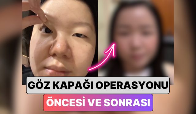 guney-korede-bir-bayan-en-yaygin-estetiklerden-biri-olan-goz-kapagi-operasyonu-ile-yasadigi-RQAmJSRV.jpg