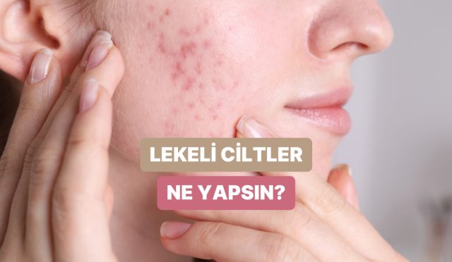 leke-gorunumune-sahip-ciltlerin-uygulamasi-gereken-tesirli-bakim-rutini-teklifleri-dQzNGGuj.jpg
