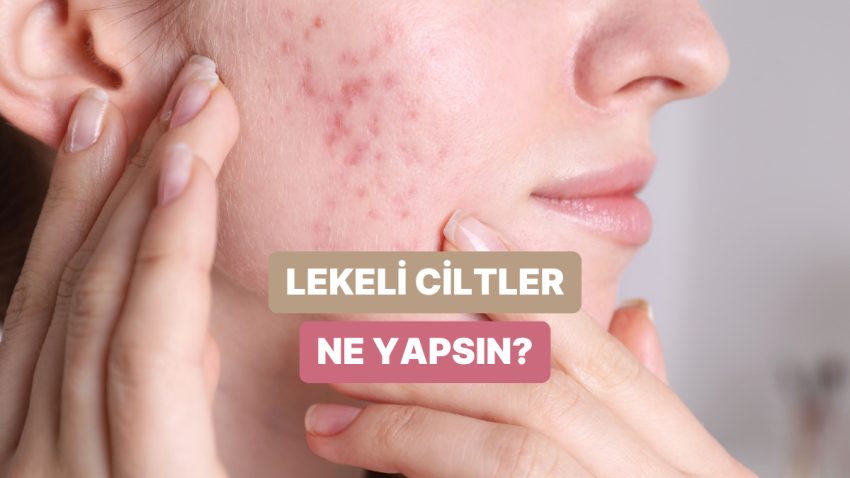 Leke Görünümüne Sahip Ciltlerin Uygulaması Gereken Tesirli Bakım Rutini Teklifleri