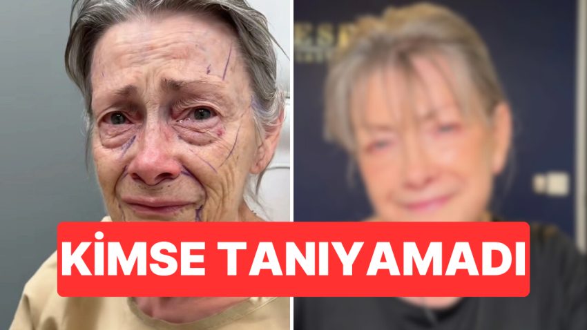 70 Yaşındaki Bayan Yüz Gerdirme Operasyonu Sonrası Gençliğine Geri Döndü