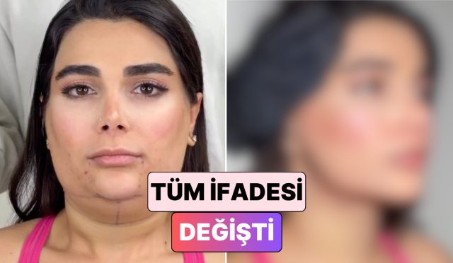 bir-bayanin-gidi-ve-yuz-germe-ameliyatindan-sonraki-degisimi-begeni-topladi-Fm2TA6DR.jpg