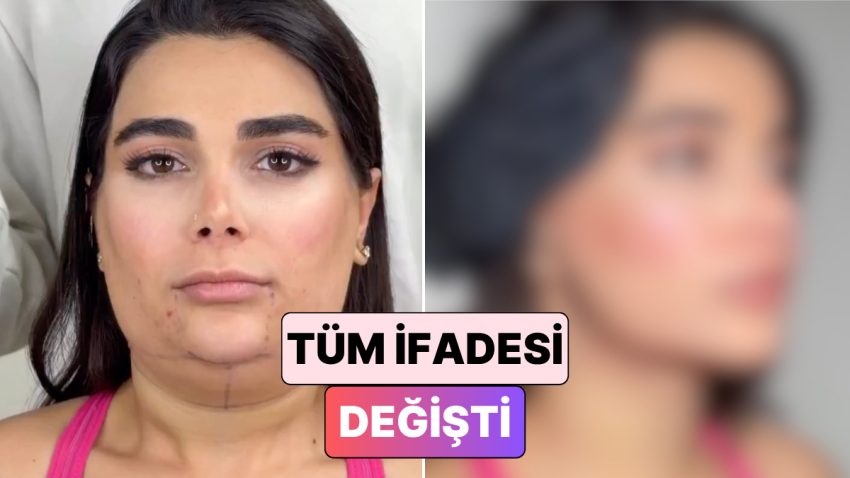 Bir Bayanın Gıdı ve Yüz Germe Ameliyatından Sonraki Değişimi Beğeni Topladı