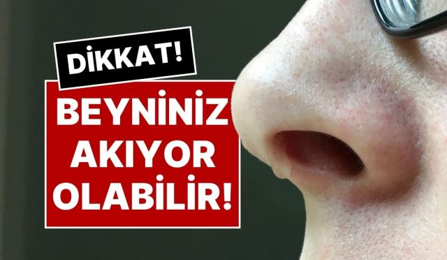 gecmeyen-burun-akintisinin-nedeni-nedir-beyin-siviniz-akiyor-olabilir-ujzQhqMf.jpg