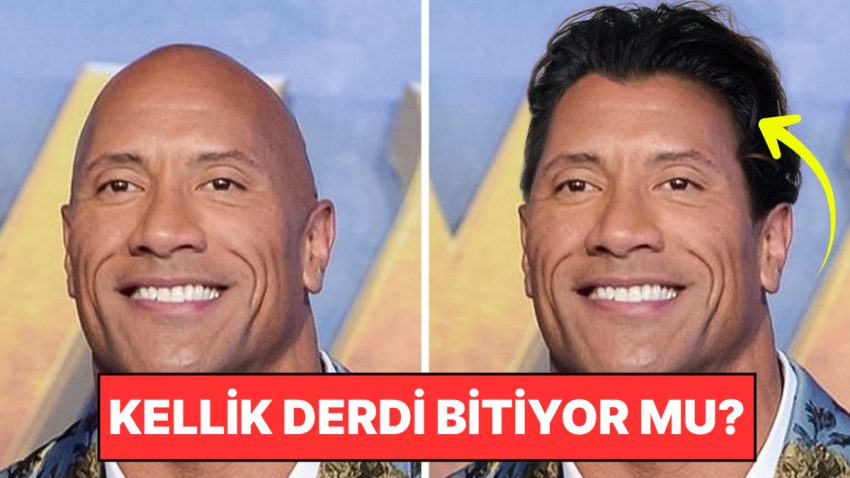 Kellik Tarihe mi Karışıyor? Bilim İnsanları Saçın Tekrar Uzamasını Sağlayan Serum Keşfetti