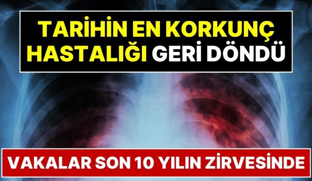 tarihin-en-vahim-hastaligi-geri-dondu-covidden-daha-olumcul-olabilir-jiYDRhRz.jpg