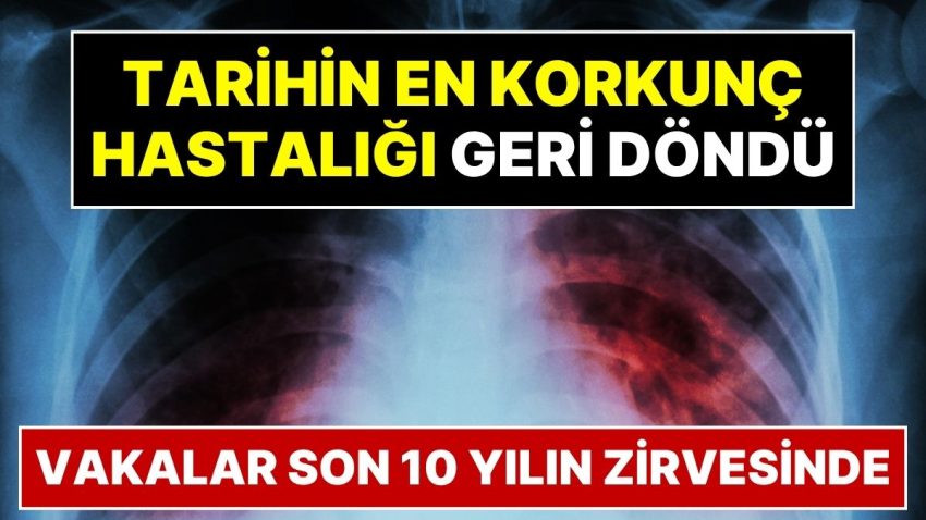 Tarihin En Vahim Hastalığı Geri Döndü: COVID’den Daha Ölümcül Olabilir!