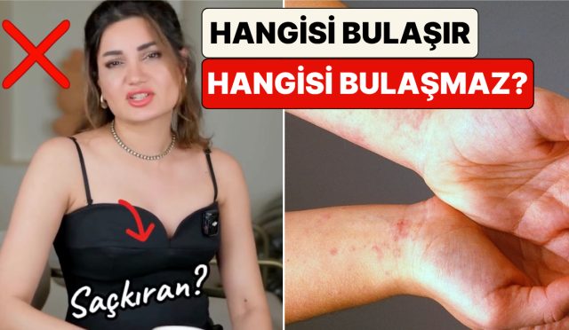 uzman-dermatolog-cilt-hastaliklarinin-hangilerinin-bulasici-hangilerinin-olmadigini-anlatti-67ac9k15.jpg