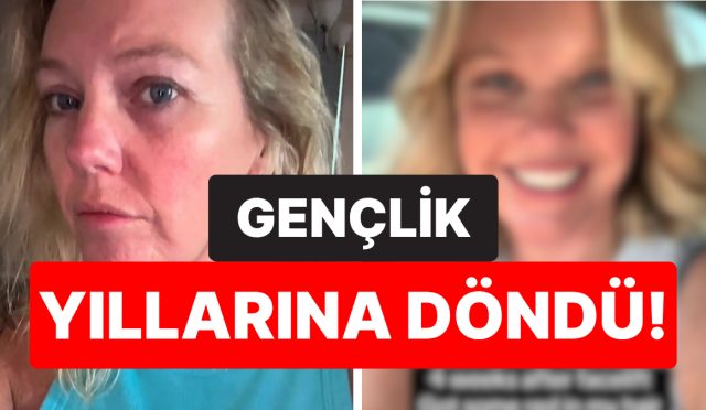 yuz-gerdirme-yaptirdiktan-sonra-genclik-yillarina-donen-45-yasindaki-bayanin-son-hali-sasirtti-KY4GcyuC.jpg