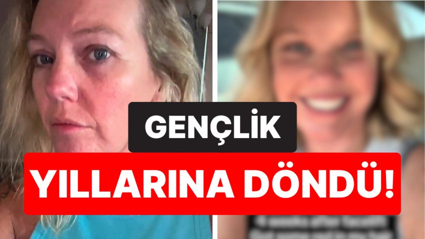 Yüz Gerdirme Yaptırdıktan Sonra Gençlik Yıllarına Dönen 45 Yaşındaki Bayanın Son Hali Şaşırttı