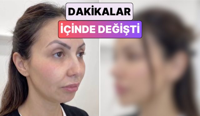 yuzunun-bes-farkli-bolgesine-dolgu-yaptiran-bayanin-degisimi-viral-oldu-dWv32w7e.jpg
