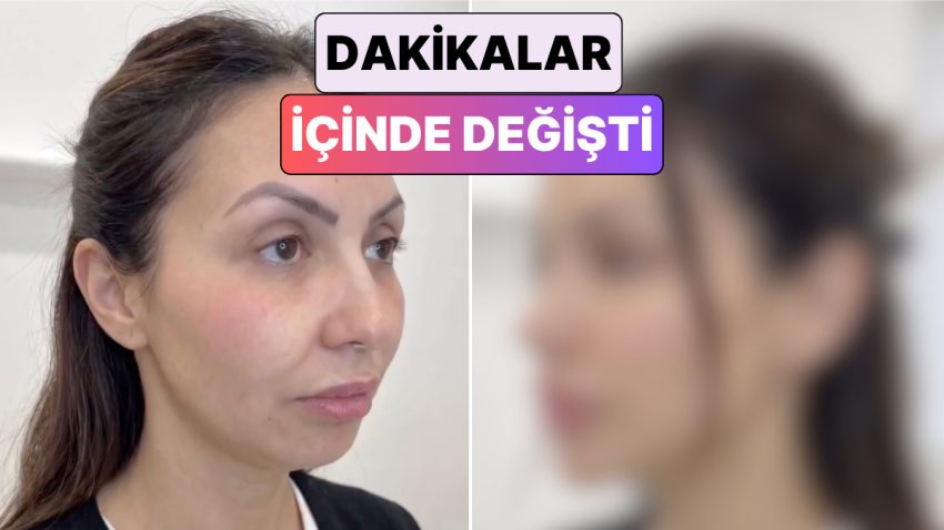 Yüzünün Beş Farklı Bölgesine Dolgu Yaptıran Bayanın Değişimi Viral Oldu